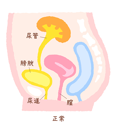 異所性尿管説明1