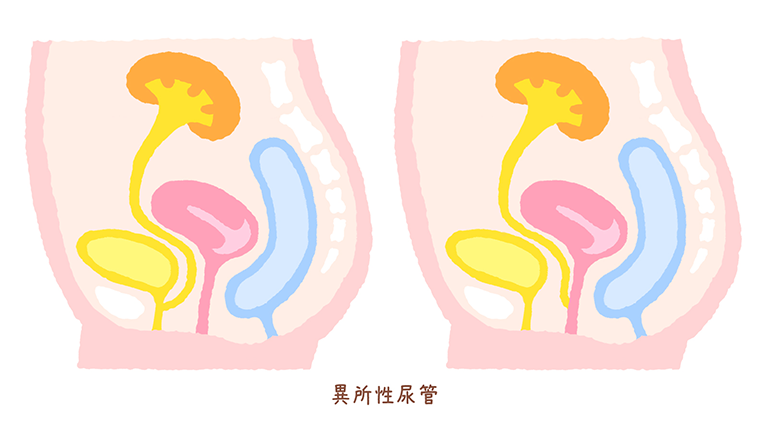 異所性尿管説明2